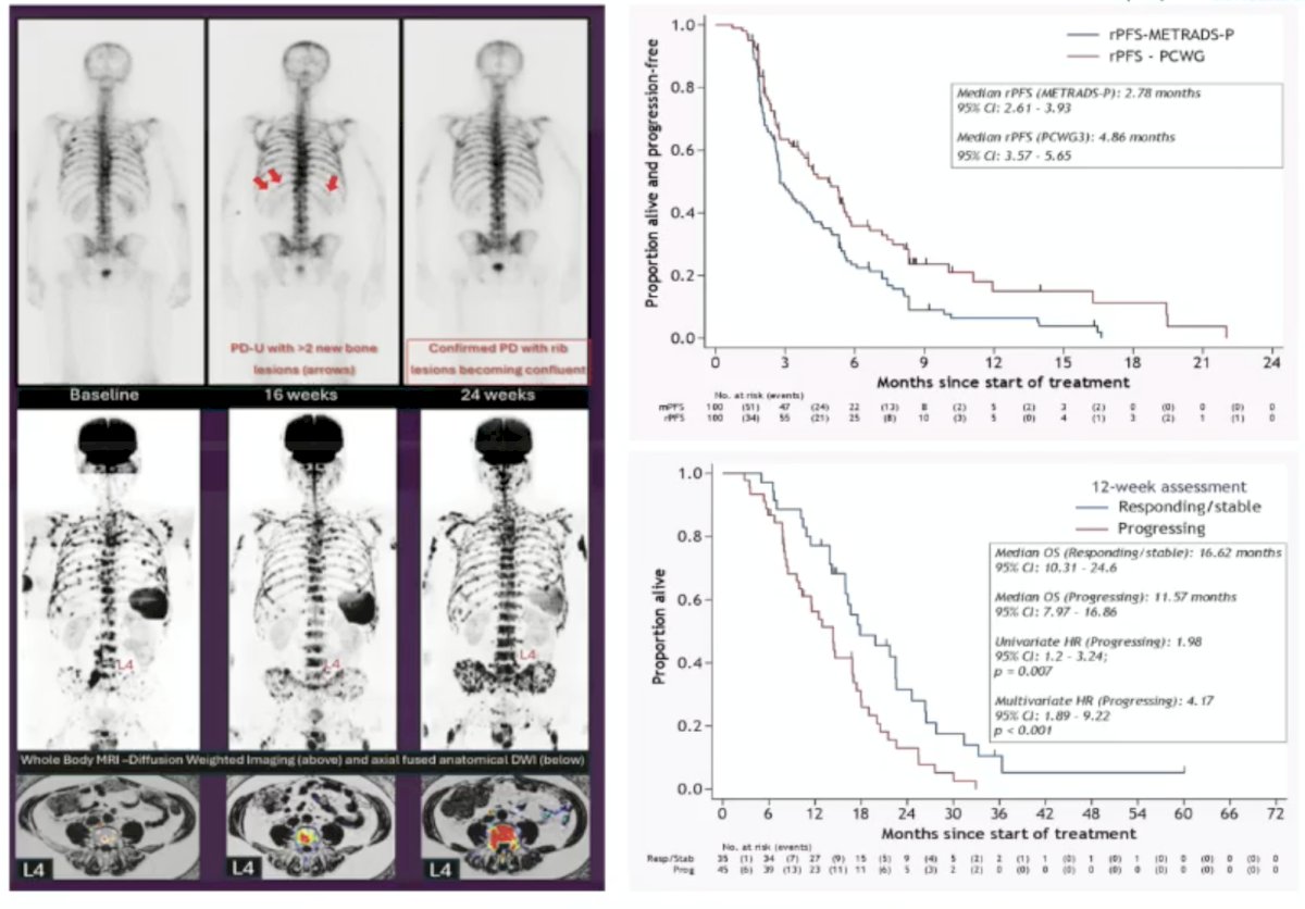 Dr. von Amsberg then discussed whole body MRI, which identifies substantial progression missed by conventional imaging: 43% versus CT and 75% versus bone scan in the PROSPECT interim analysis. Of note, 2/3 of patients achieving a PSA50 response showed progression on whole body MRI. Presented at ASCO 2024, Tunariu et al. assessed discordance between PSA and conventional imaging with whole-body MRI. This study found that whole body MRI detected earlier progression (radiographic progression-free survival by PCWG3) and had prognostic relevance in that progressive disease at 12 weeks is associated with worse overall survival: