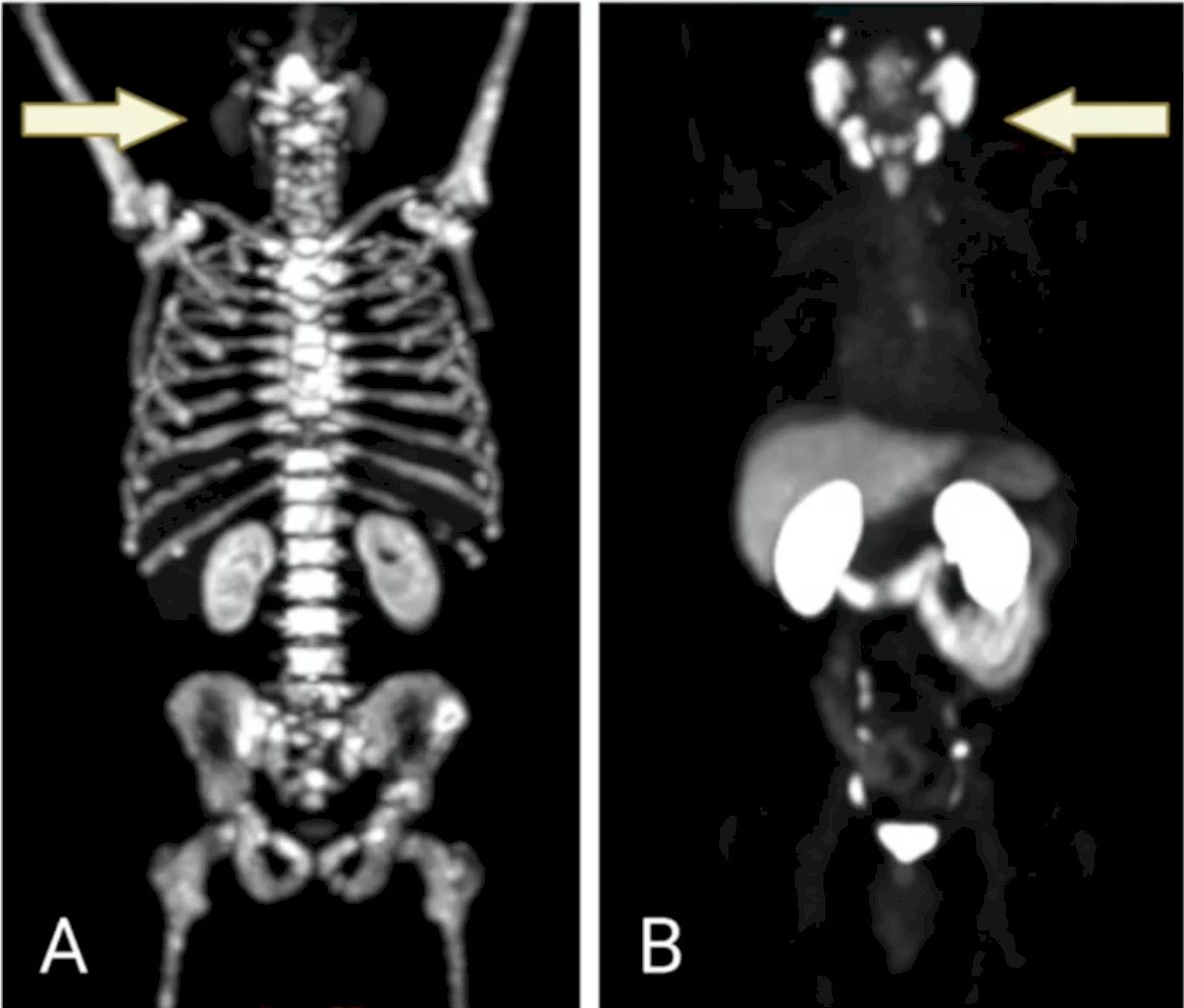 Dr. Oprea-Lager then provided case examples of patients to demonstrate the “tumor sink effect”. In panel A, this patient exhibits a very high tumor volume, with extensive PSMA-positive osseous metastases evident on 68Ga-PSMA PET/CT. The majority of the radioligand is sequestered in the numerous sites of disease, resulting in minimal uptake in the salivary glands (arrow). In panel B, this patient presents with a low volume of lymph node-only metastatic disease on baseline 68Ga-PSMA PET/CT. With a lower tumor burden, there is significantly greater radioligand uptake by the salivary glands (arrow), potentially leading to a higher degree of salivary toxicity: