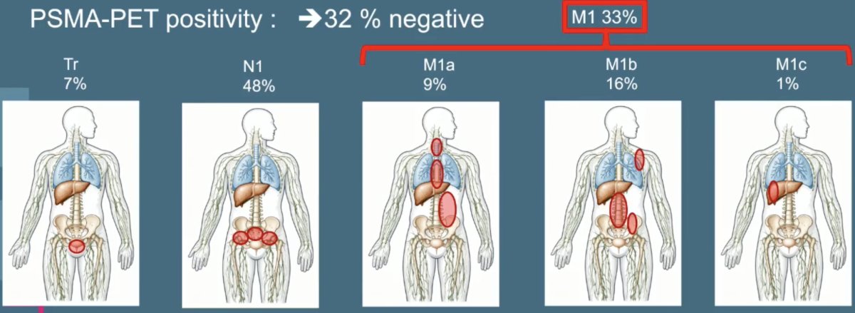 In 2019, Farolfi et al.2 assessed the ability of 68Ga-PSMA-11 PET to detect residual prostate cancer after prostatectomy. Among 191 patients, PSMA PET localized prostate cancer in 130 of 191 patients (68%) with PSA persistence at a median PSA of 1.1 ng/ml. The most frequently affected nodal regions were the obturator in 42% and the presacral/mesorectal region in 40%; 33% were M1 based on PET findings:
