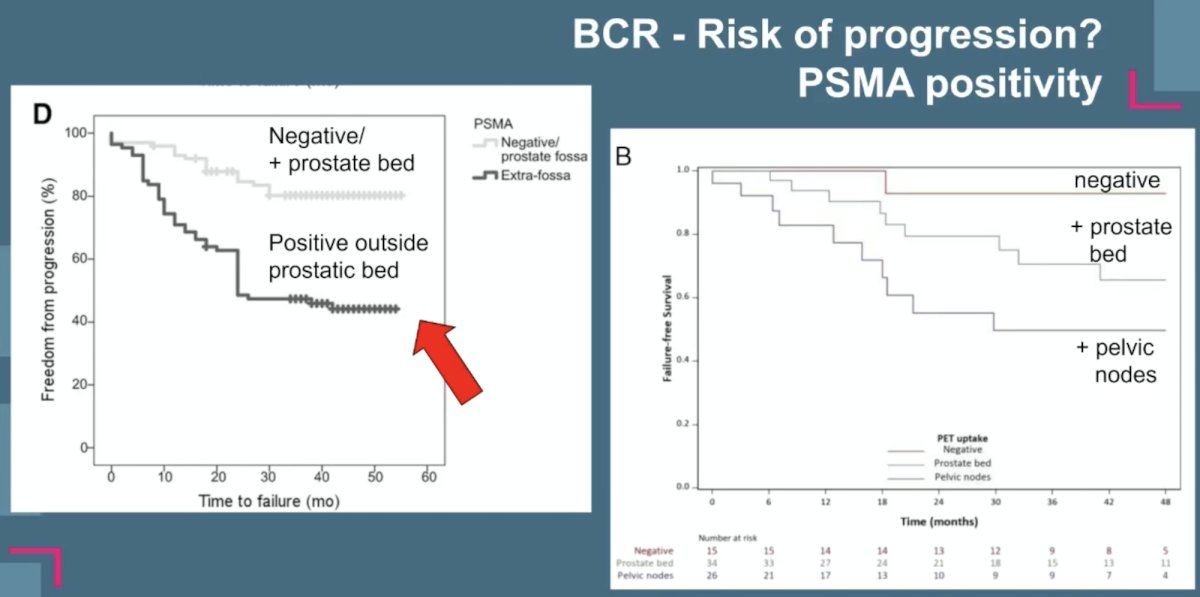 Dr. Walz notes that the EAU risk groups can also assist with predicting progression among patients with biochemical recurrence. Patients at low risk after radical prostatectomy include those with a PSA doubling time > 12 months + pathologic Grade Group < 4, whereas those at high risk after radical prostatectomy include patients with a PSA doubling time < 12 months +/- pathologic Grade Group 4-5 disease. Certainly, PSMA PET/CT is also helpful in these patients, with patients having a recurrence outside of the prostatic bed having worse outcomes compared to those with a negative PSMA PET/CT, and patients with positive lymph nodes on PSMA PET having worse outcomes compared to those with positive disease in the prostate bed: