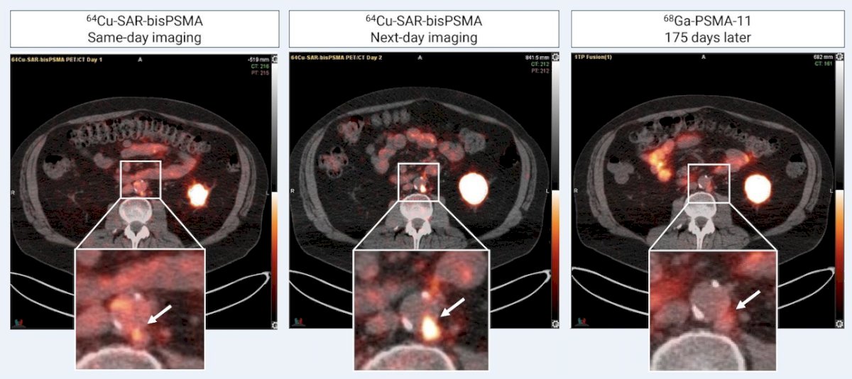 64Cu-SAR-bisPSMA PET/CT also detected more lesions up to 6 months earlier than standard of care PSMA PET in participants who received 18F-DCFPyL or 68Ga-PSMA-11 during COBRA follow-up: