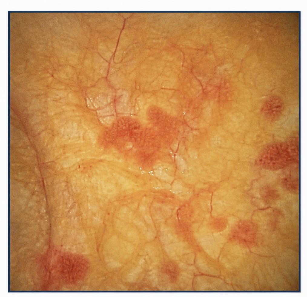 The patient declined additional adjuvant therapy following initial treatment. At 6-month surveillance cystoscopy, several recurrent lesions measuring up to 5 mm were identified in the bladder dome, as shown below: