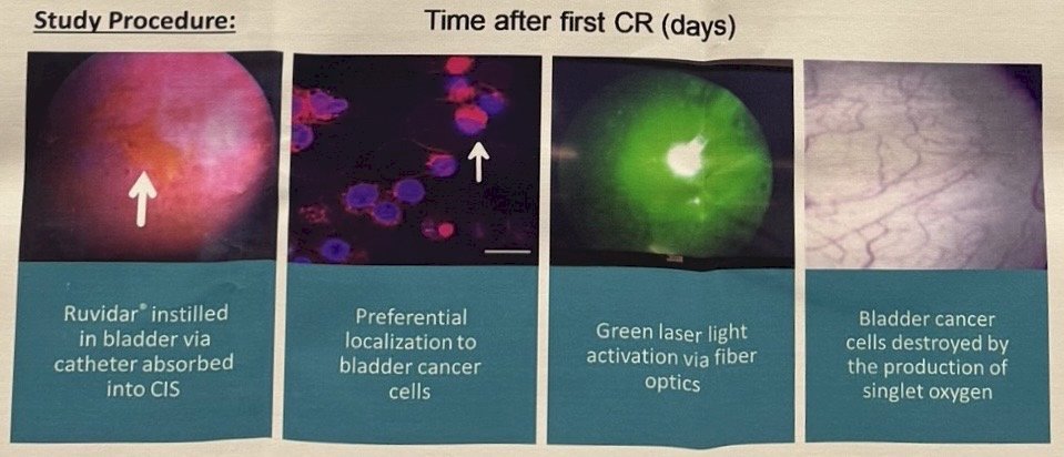 This study enrolled 91 patients, of whom 82 completed treatment and follow-up assessments. Patients underwent intravesical instillation of TLD-1433 followed by photoactivation using the TLC-3200 laser system under general anesthesia. The treatment utilized a 520 nm laser with light activation delivered at 90 J/cm² as shown in the figure below.