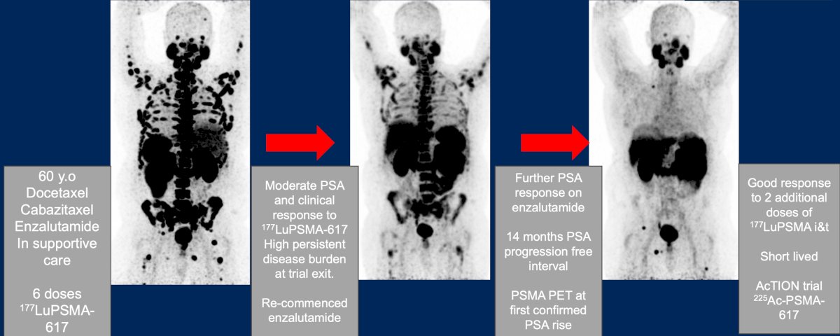 The role of ARPI rechallenge in conjunction with radioligand therapy was further explored through a clinical case presentation. A 60-year-old patient who had previously received docetaxel, cabazitaxel, and enzalutamide underwent six doses of 177Lu-PSMA-617, achieving a moderate PSA and clinical response but maintaining substantial residual disease burden at treatment completion. Upon restarting enzalutamide, the patient experienced an additional PSA response and achieved a 14-month PSA progression-free interval. Subsequent PSMA PET imaging at PSA progression demonstrated renewed sensitivity to additional radioligand therapy, with two further doses of 177Lu-PSMA-I&T producing another clinical response. The patient was ultimately enrolled in the AcTION trial for 225Ac-PSMA-617: