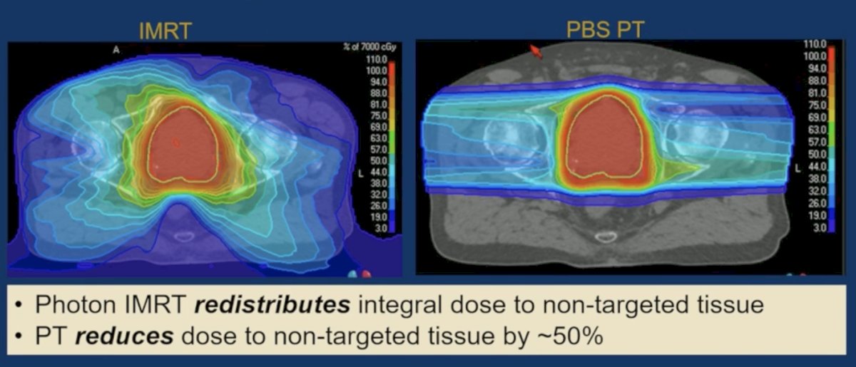 Dosimetric comparison demonstrated substantially lower radiation exposure to non-targeted tissues with proton therapy relative to conventional IMRT. Specifically, proton therapy reduced dose to normal tissues by approximately 50% compared with IMRT, with the dose distribution visualization illustrating minimal moderate-to-low dose exposure in surrounding tissues with PT versus more extensive dose exposure observed with conventional IMRT.