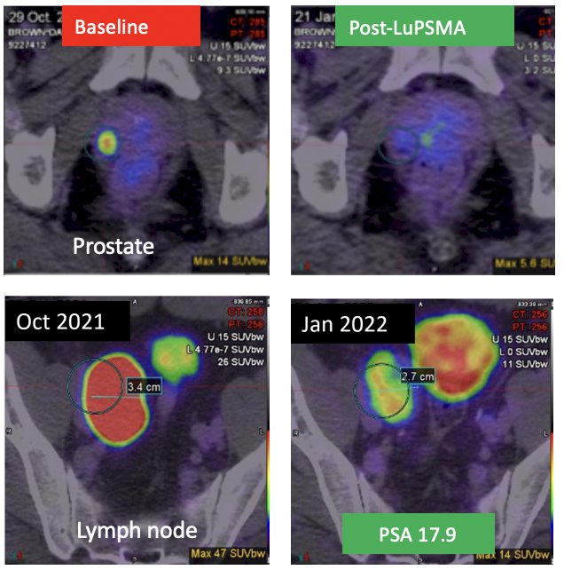 LuTectomy9 is an innovative neoadjuvant radioligand therapy approach being evaluated before radical prostatectomy. Dr. Eapen highlighted the experience of a 62-year-old man who initially presented with a PSA of 334 ng/mL, clinical stage cT1c disease, PIRADS 2 findings, Grade Group 1 disease, cN1 lymph node involvement, and a PSMA PET SUVmax of 47. Following a 177Lu-PSMA-617 cycle of treatment, his PSA declined to 17.9 ng/mL, and he subsequent underwent a robotic radical prostatectomy, which demonstrated pT3a Grade Group 4 disease with negative surgical margins and pathologic nodal involvement (pN1). Most notably, the patient maintained a PSA <0.2 ng/mL at 18 months of follow-up: