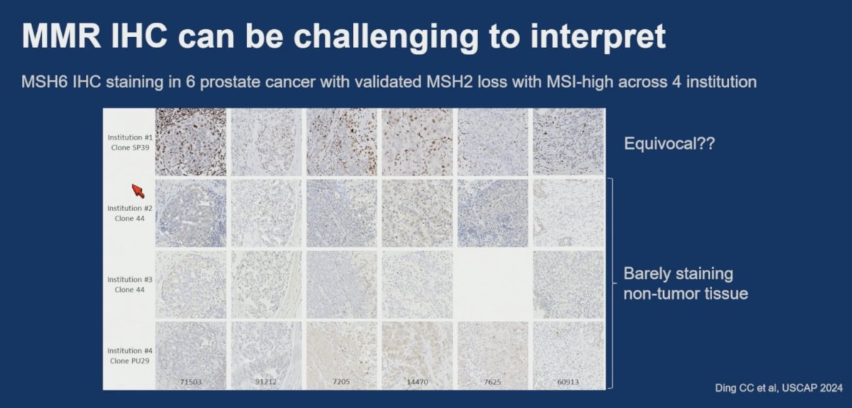 To illustrate these challenges, Dr. Ding presented examples of MSH6 staining in prostate cancers with validated MSH2 loss and MSI-high status across four institutions. Marked variability in staining intensity and patterns was observed, with some cases appearing equivocal and others demonstrating minimal staining of non-tumor tissue, underscoring the potential difficulties associated with interpretation.&nbsp;