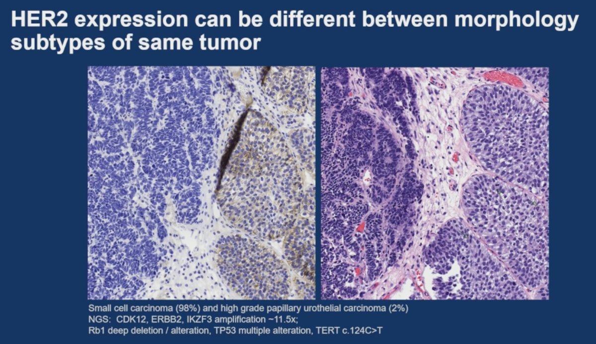 Importantly, Dr. Ding highlighted the issue of intratumoral heterogeneity. She presented a urothelial carcinoma specimen containing both small-cell carcinoma and high-grade papillary urothelial carcinoma components that demonstrated markedly different HER2 expression patterns despite shared underlying genomic alterations. These findings emphasize the importance of morphology-aware biomarker assessment and careful pathologic review.