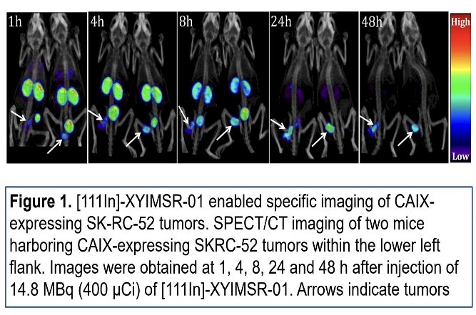 The figure below demonstrates a clear visualization of a metastatic lesion with marked radiotracer uptake. Quantitative analysis demonstrated a lesion maximum standardized uptake value (SUVmax) of 4.8 compared with a liver SUVmax of 1.4, corresponding to a lesion-to-liver uptake ratio of approximately 3.4. These findings support selective accumulation of [111In]-XYIMSR-01 within metastatic ccRCC lesions and provide early evidence of favorable imaging characteristics.