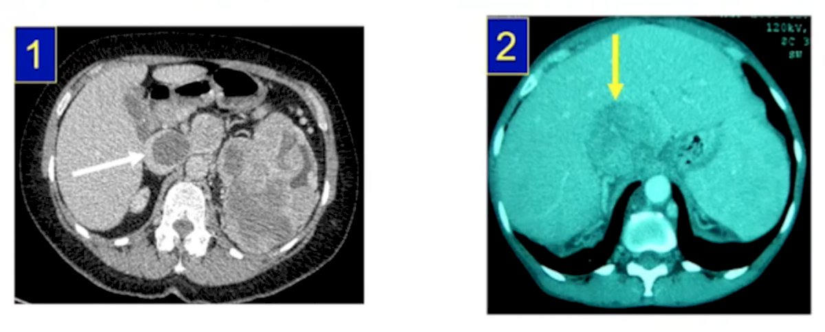 Recurrent Disease-4.jpg