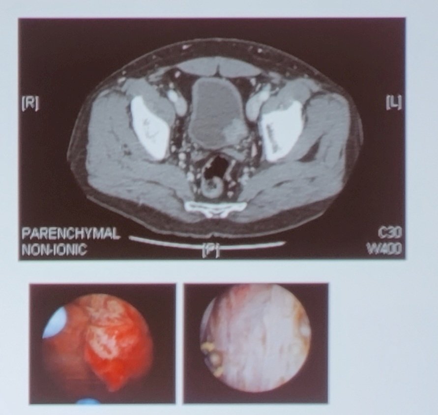 bladder sparing surgery-1.jpg