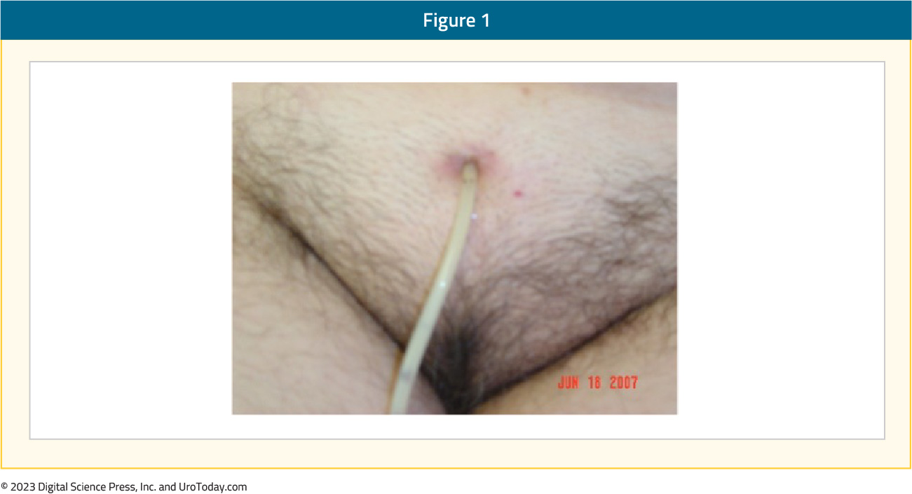 figure-1-suprapubic-catheter-changing2x.jpg