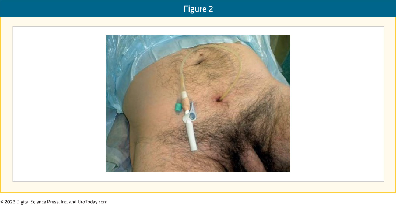 figure-2-suprapubic-catheter-changing2x.jpg