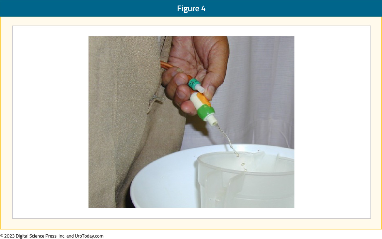 figure-4-urinary-catheter-valves2x.jpg