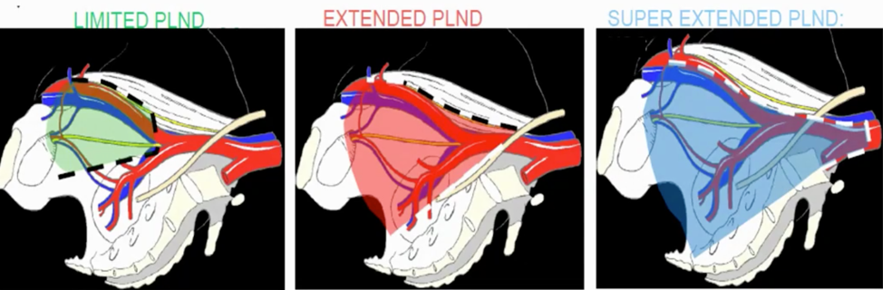 ideal extent of dissection