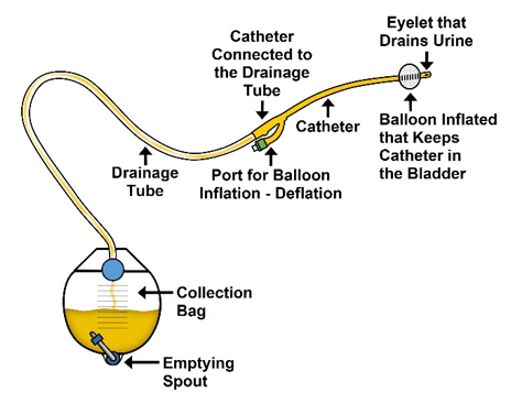 Covidien Dover 2-Way Foley Catheter Tray With Drain Bag