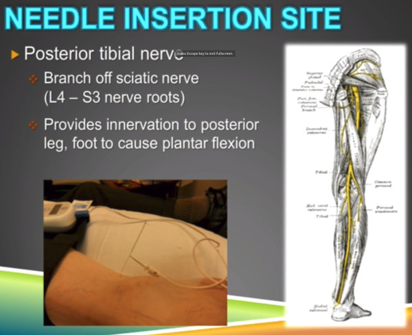 Posterior Tibial Nerve medical illustration