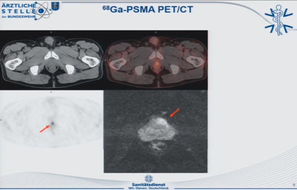 PSMA PET CT scan of Anterior Prostate