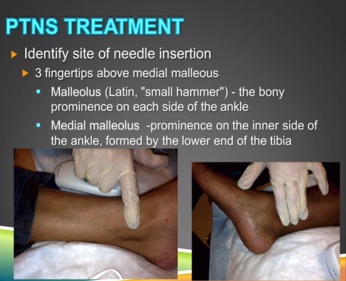 PTNS Needle Insertion point on patients leg