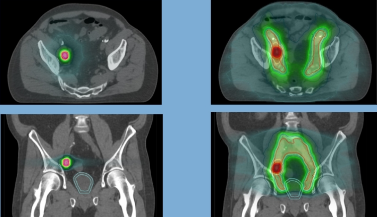 radiotherapy approaches