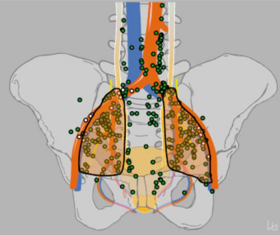 removal of lymph nodes