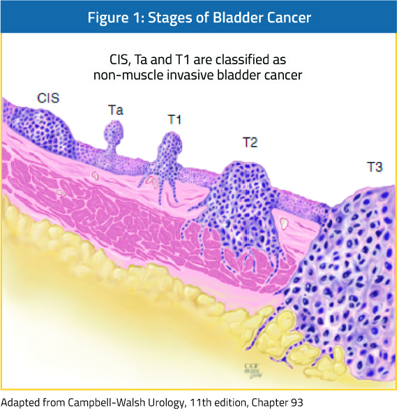 stages_of_bladder_cancer.jpg