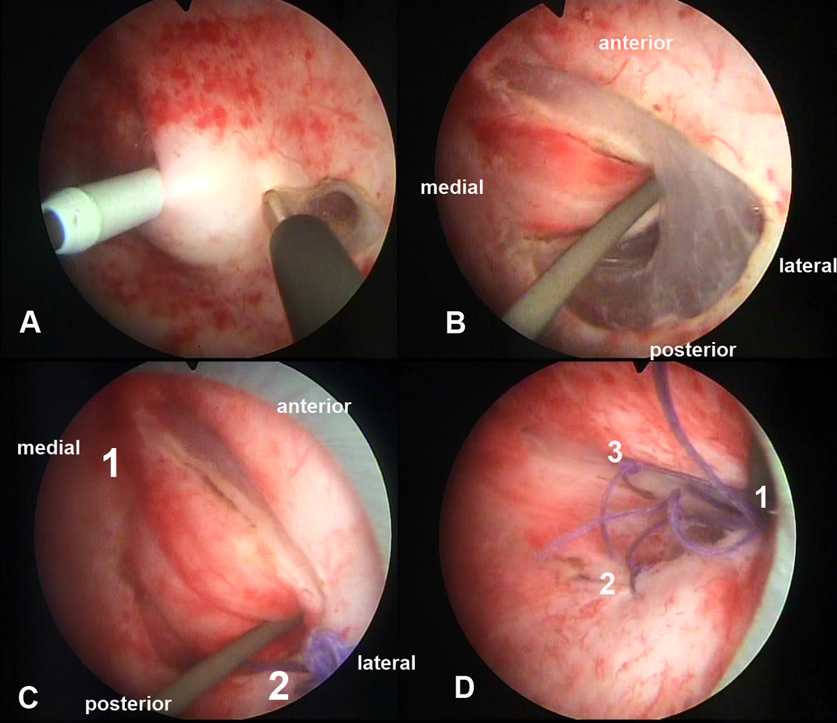 Novel application of the sewing machine principle; a new simplified  intracorporeal suturing technique for pediatric inguinal her