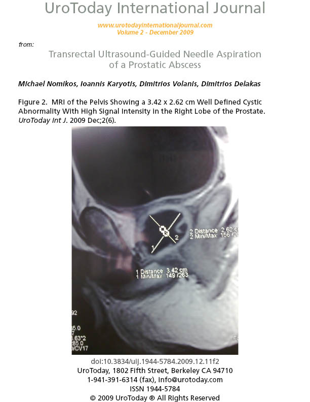 prostatic abscess drainage