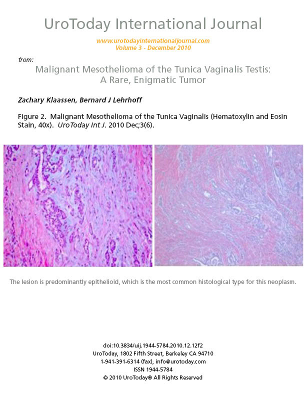 malignant mesothelioma ihc staining