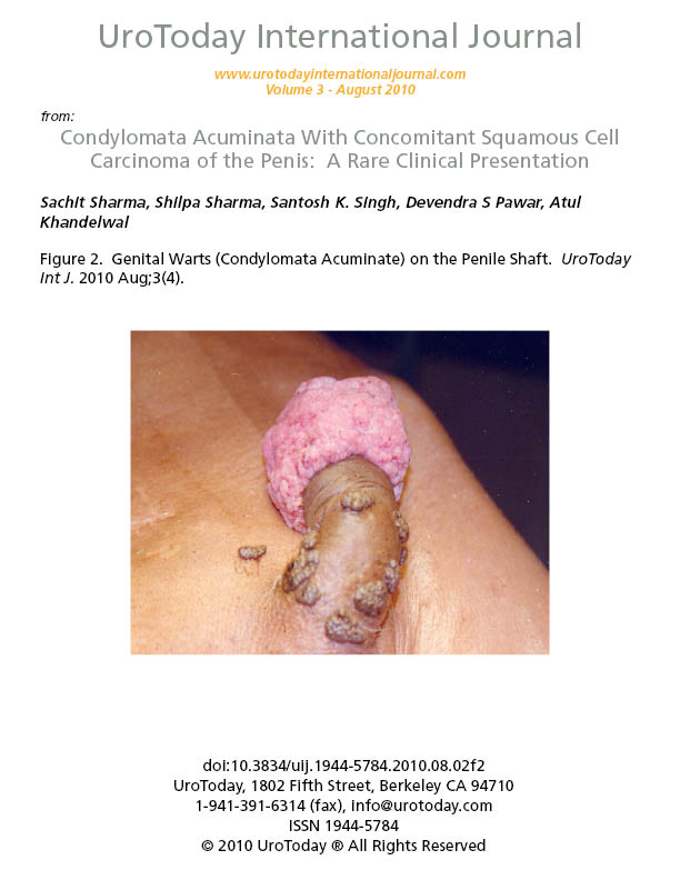 condylomata acuminata and human genital cancer)