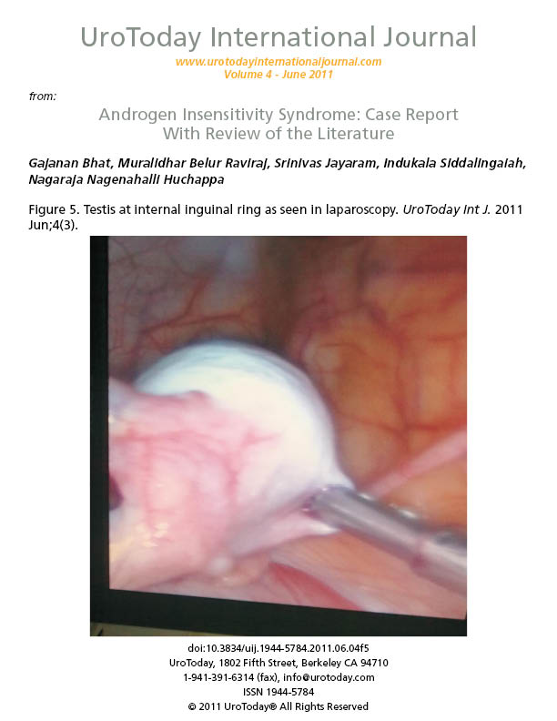 Androgen Insensitivity Syndrome: Case Report With Review of the Literature.