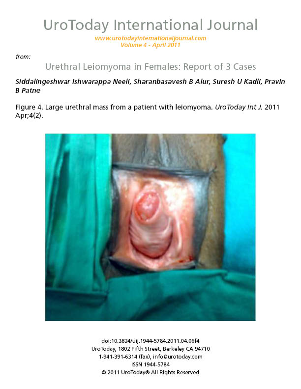 Urethral Leiomyoma in Females: Report of 3 Cases