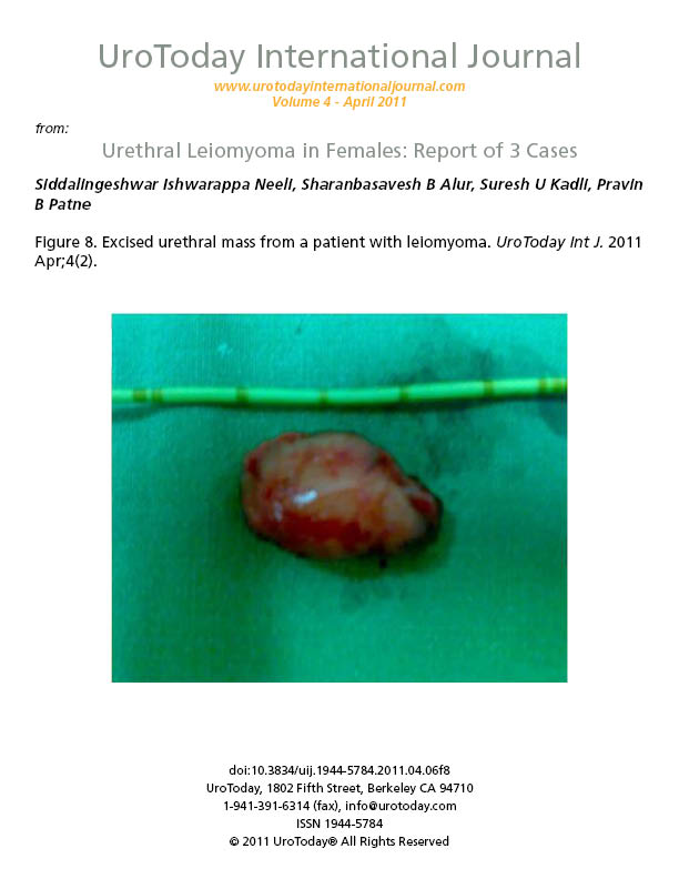 Urethral Leiomyoma in Females: Report of 3 Cases