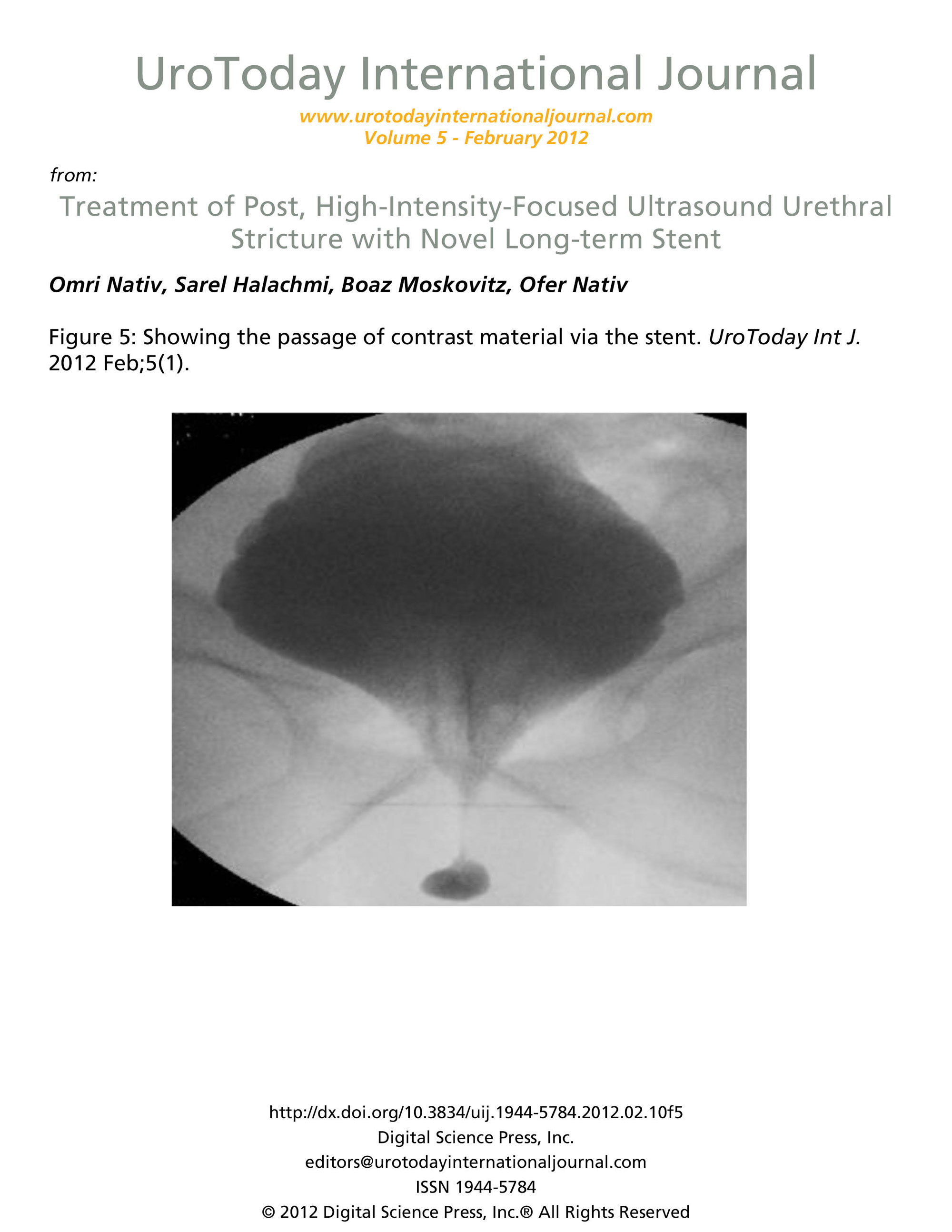 Treatment of Post, High-Intensity-Focused Ultrasound Urethral