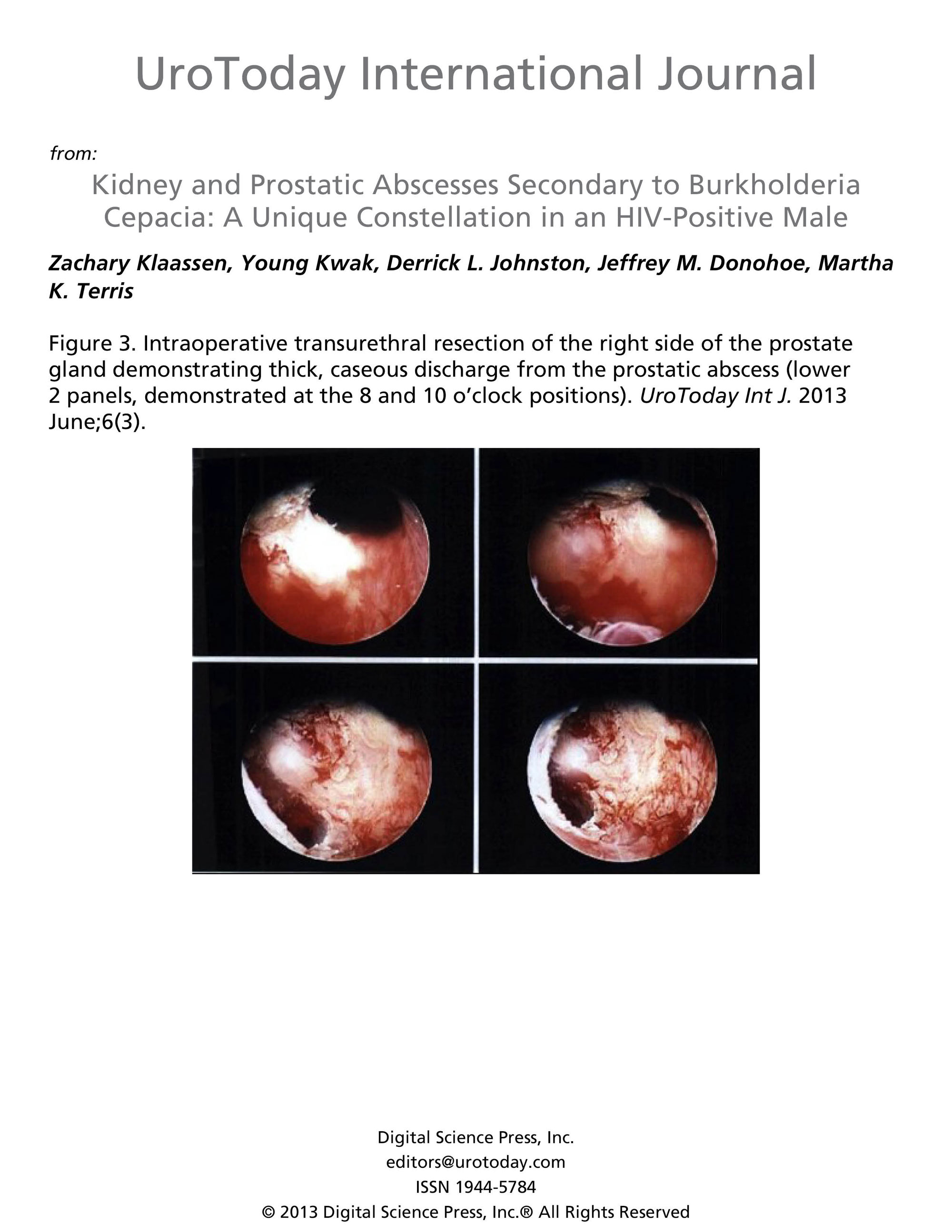 prostatic abscess symptoms